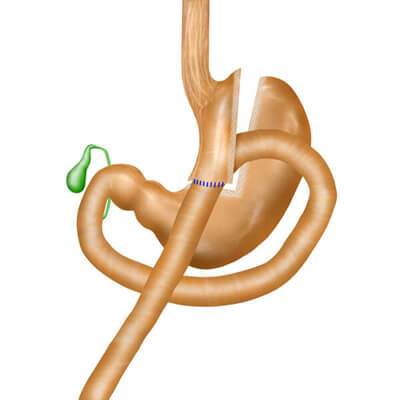 omega-loop-gastric-bypass